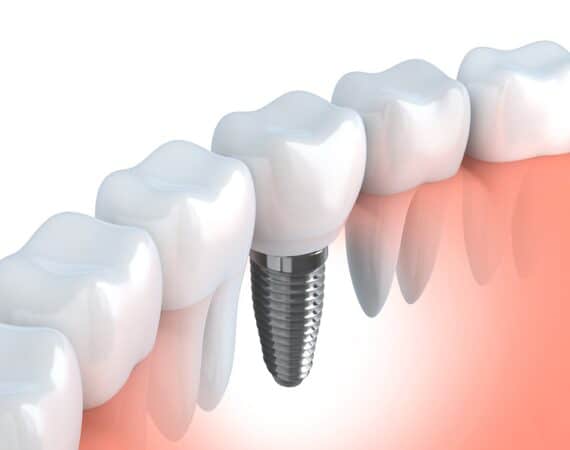 Co jest korzystniejsze: implant zębowy czy inne uzupełnienie protetyczne?